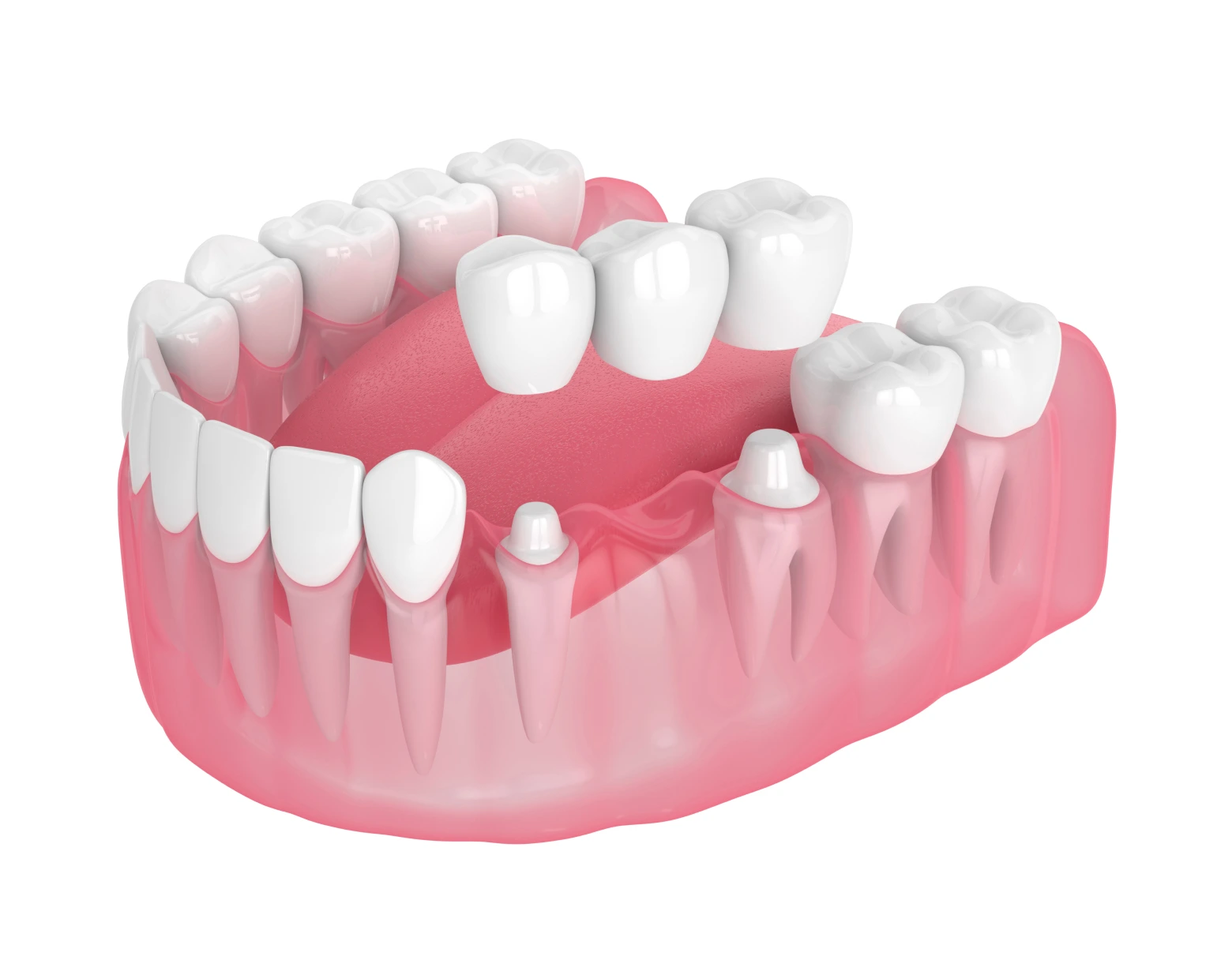 Modelo de dentadura con dientes naturales y prótesis dentales, ilustrando opciones de prótesis orales en La Clínica Dental.