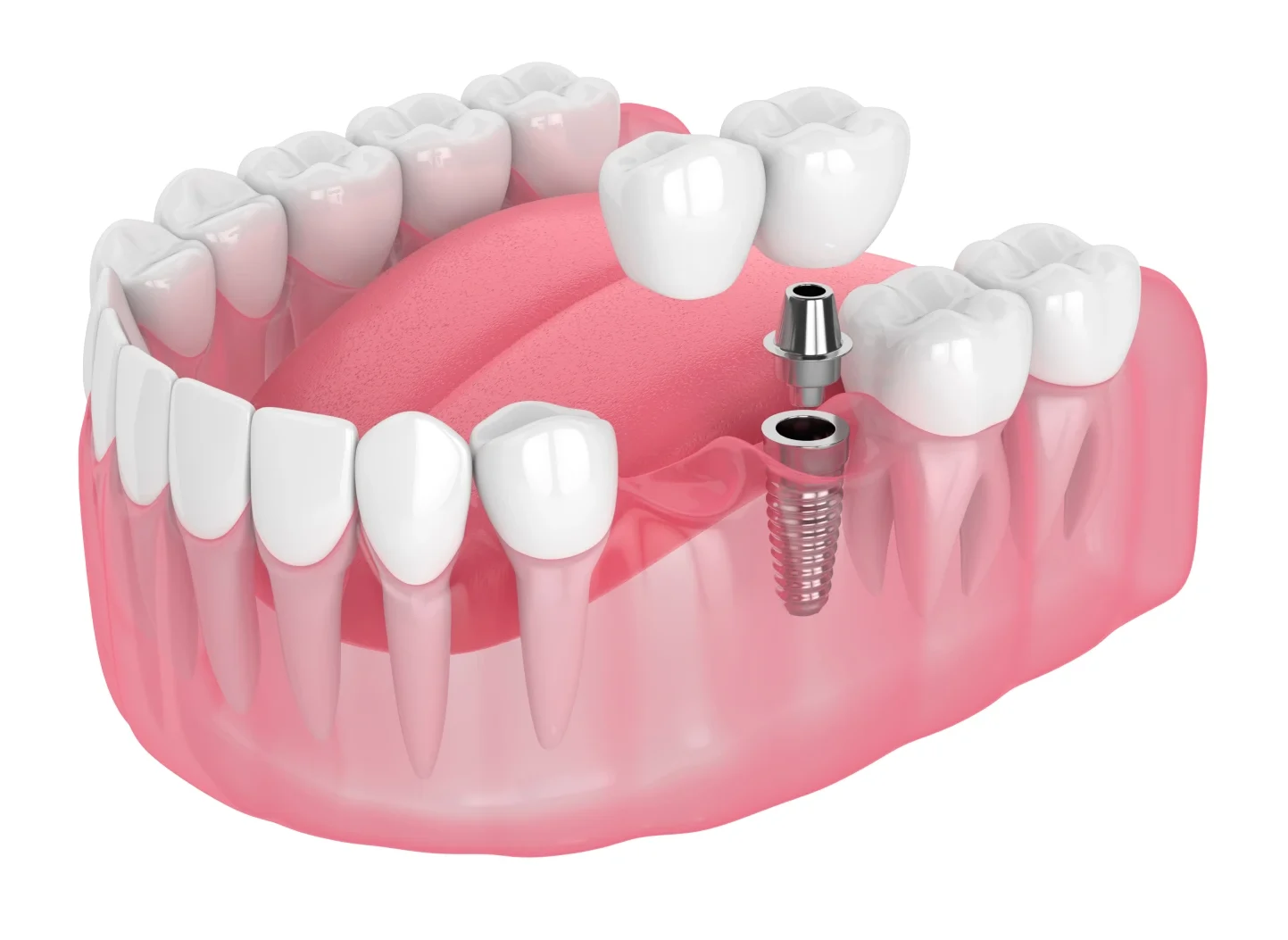 Modelo de mandíbula con implante dental, mostrando el tornillo de titanio integrado al hueso, el pilar y la corona, ilustrando el sistema de tres partes de un implante dental unitario.