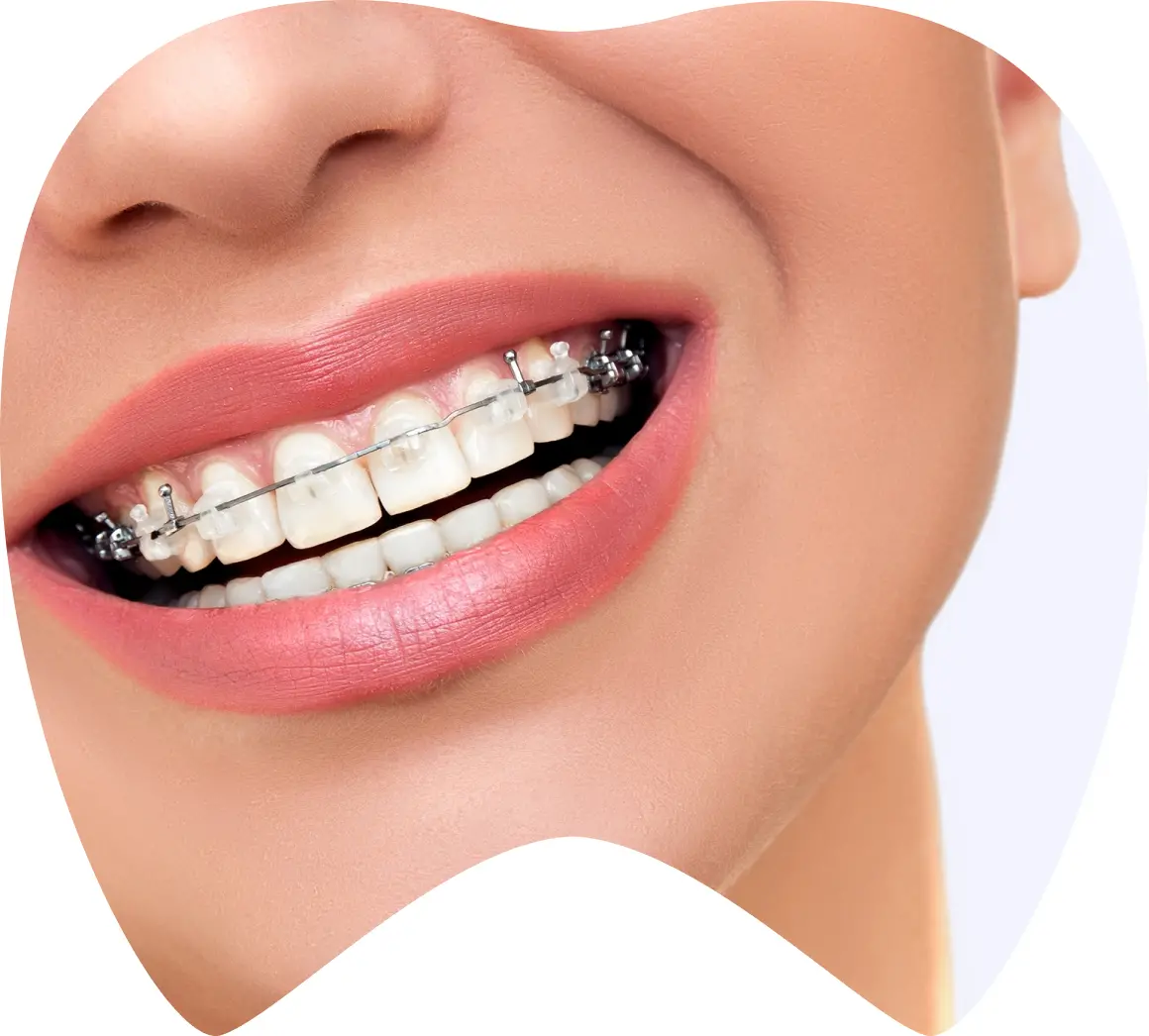 Mujer sonriendo con brackets estéticos en dientes, representando opciones de ortodoncia en La Clínica Dental.