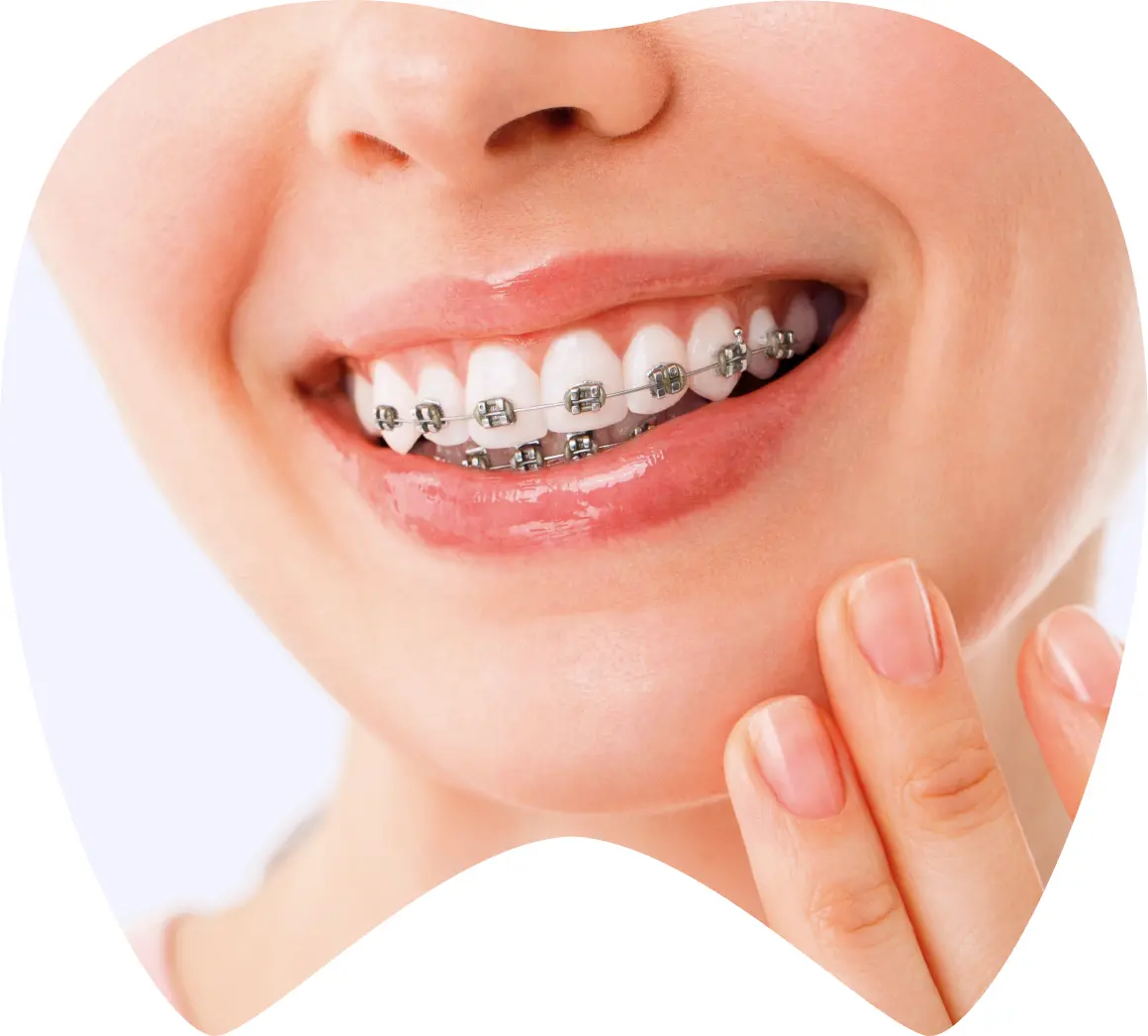 Mujer sonriendo con brackets metálicos en los dientes, destacando el tratamiento de ortodoncia en La Clínica Dental.