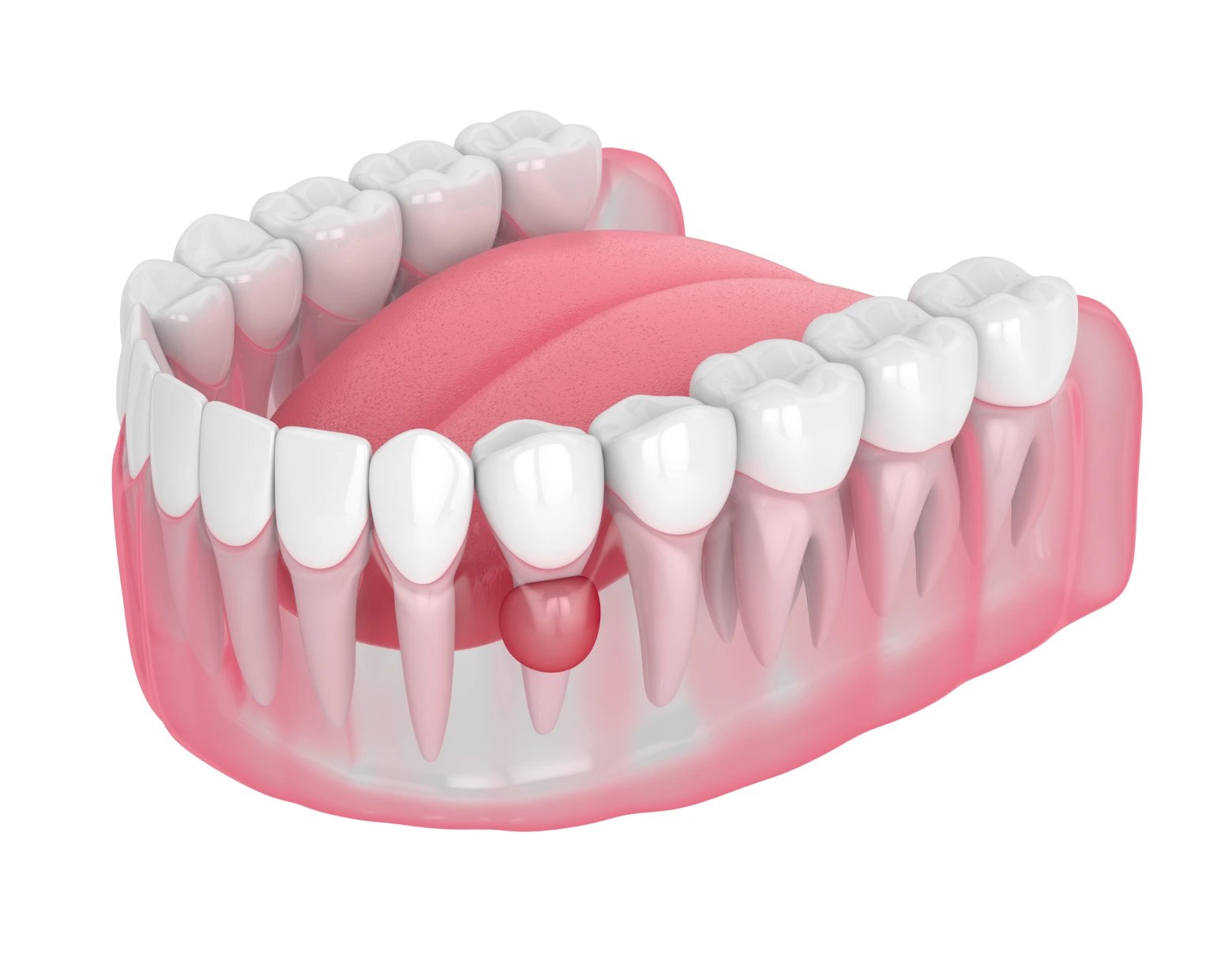 Modelo de dientes con encías inflamadas y punto rojo, ilustrando problemas de salud periodontal y la importancia del cuidado de las encías en la prevención de enfermedades dentales.