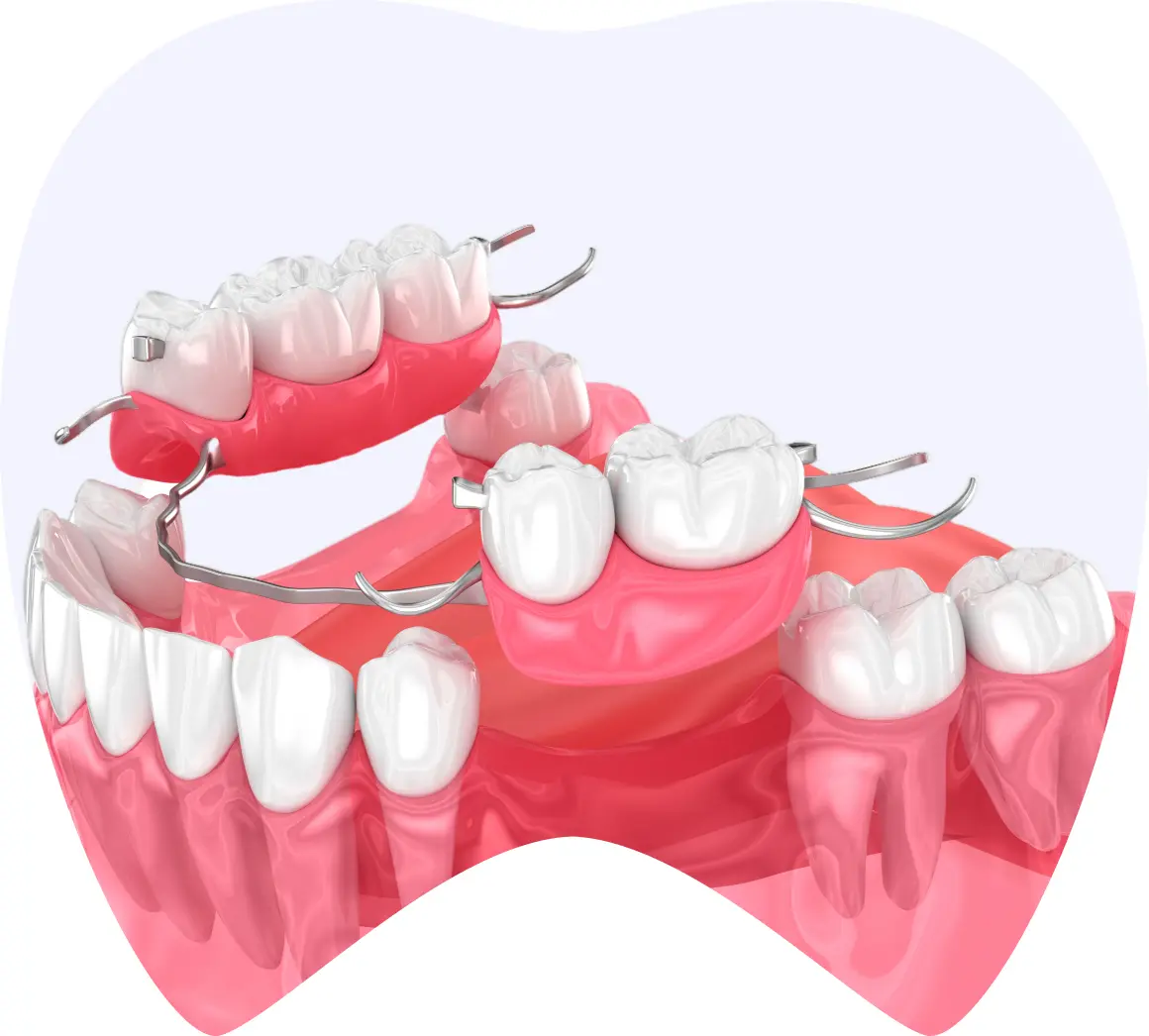 Protesis dental removible con ganchos metálicos, mostrando dientes artificiales y encías, representando opciones de restauración oral en La Clínica Dental.