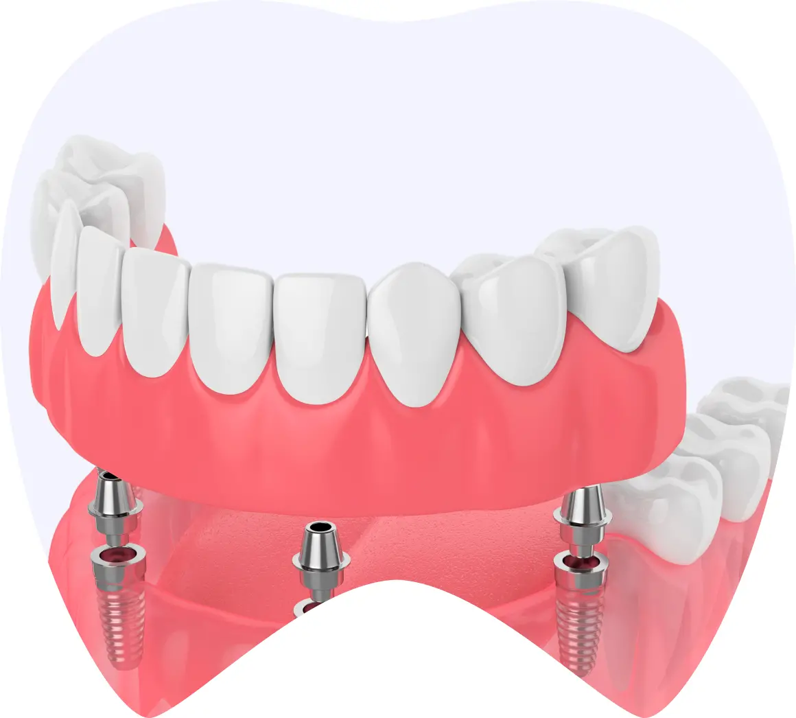 Protesis dental fija con implantes, mostrando dientes artificiales y base de encía, representando la restauración de funcionalidad y estética en La Clínica Dental.