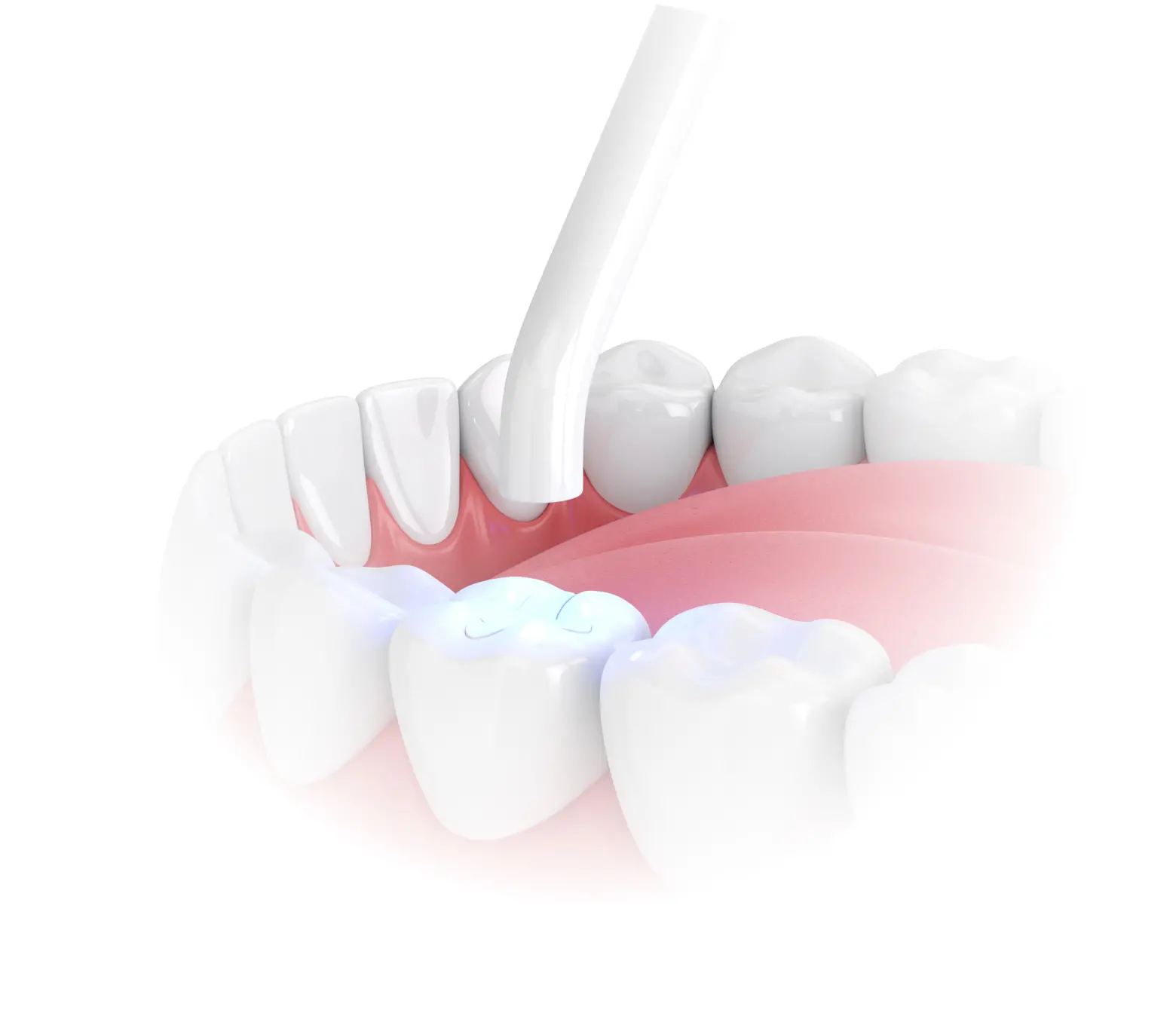 Imagen de dientes con resina estética aplicada y herramienta dental iluminada, destacando el tratamiento de corrección de imperfecciones dentales.