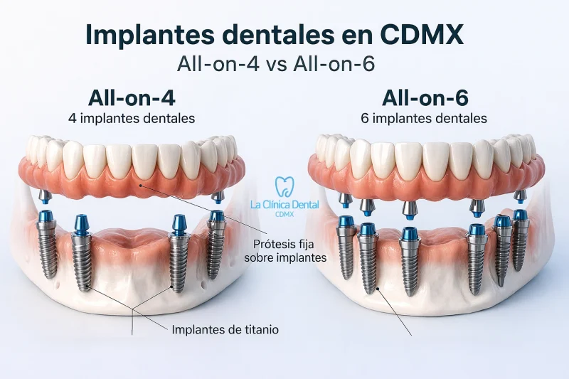 Implantes dentales en CDMX, comparación entre All-on-4 con 4 implantes y All-on-6 con 6 implantes, destacando prótesis fija sobre implantes y materiales de titanio, La Clínica Dental CDMX.