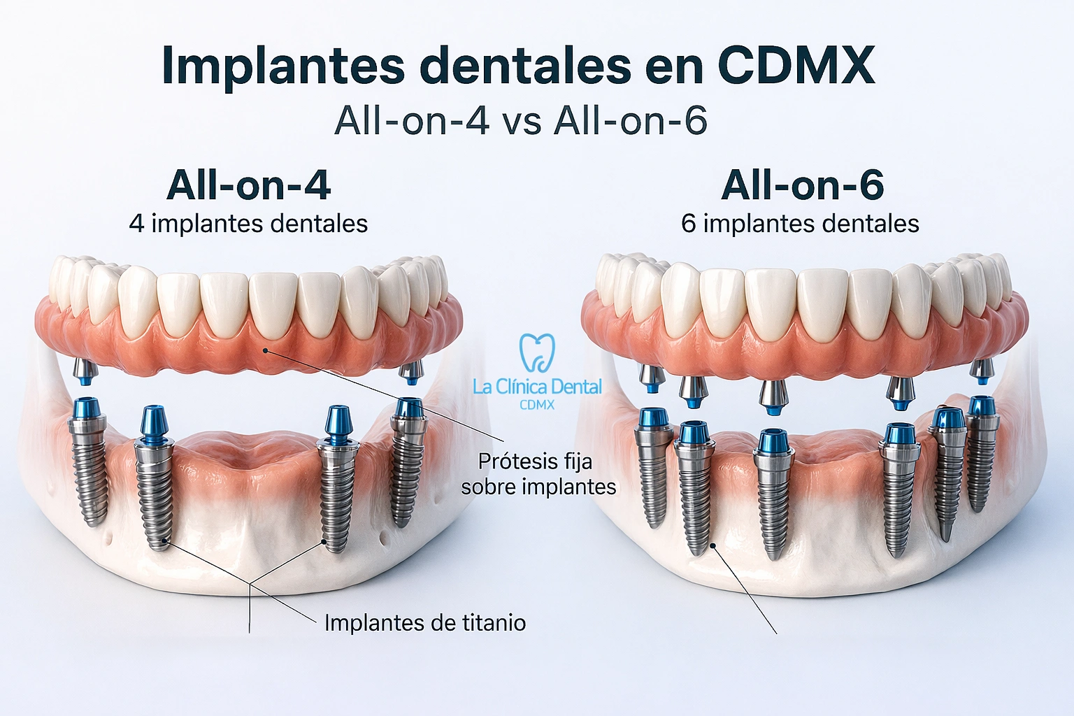 Implantes dentales en CDMX, comparación entre All-on-4 y All-on-6, mostrando prótesis fija sobre 4 y 6 implantes dentales.
